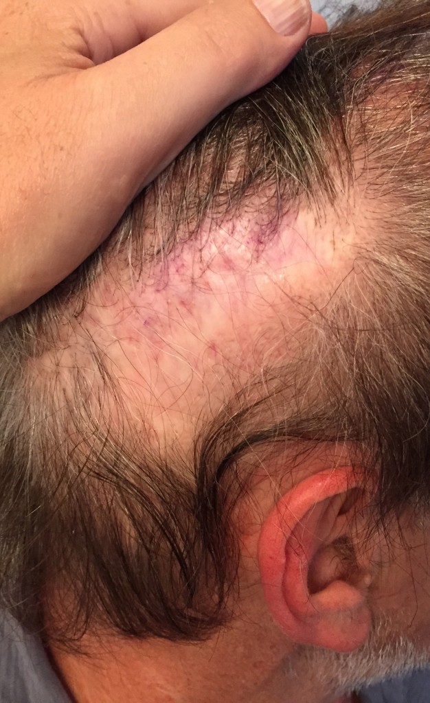 This is a patient who had a widened strip scar following strip hair transplant.