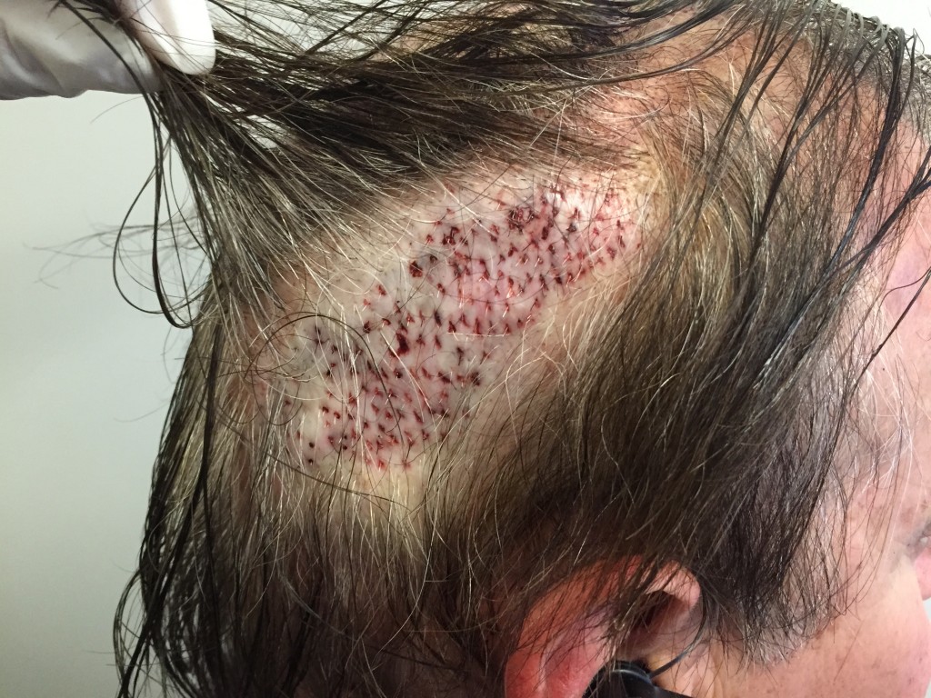 This is a patient who had beard hair extracted via FUE transplanted into a previous strip scar.
