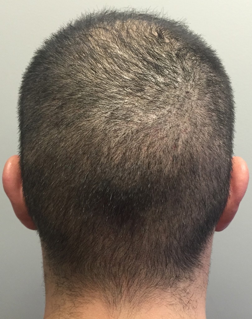 This is the donor region one week after extracting just over 1500 grafts via FUE