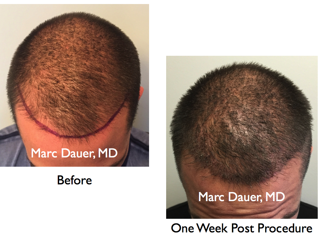 This is the recipient region pre FUE hair transplant and 1 week after just over 1100 grafts were placed in the hairline.