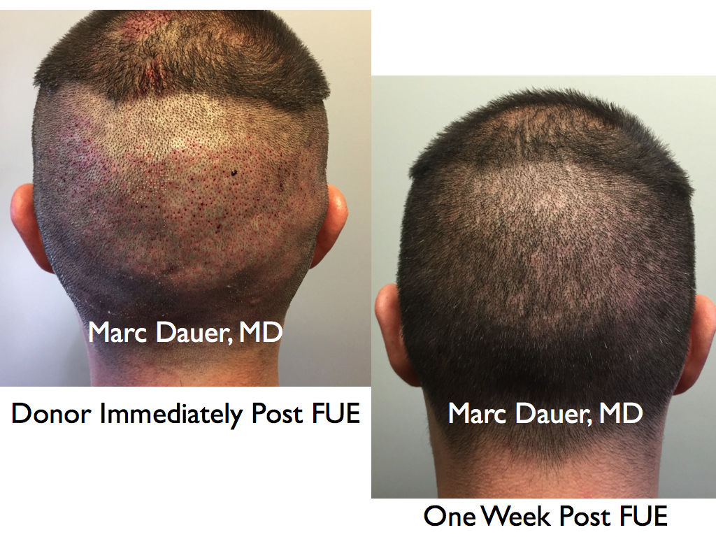 This is the donor region immediately post FUE hair transplant and 1 week afterward. 