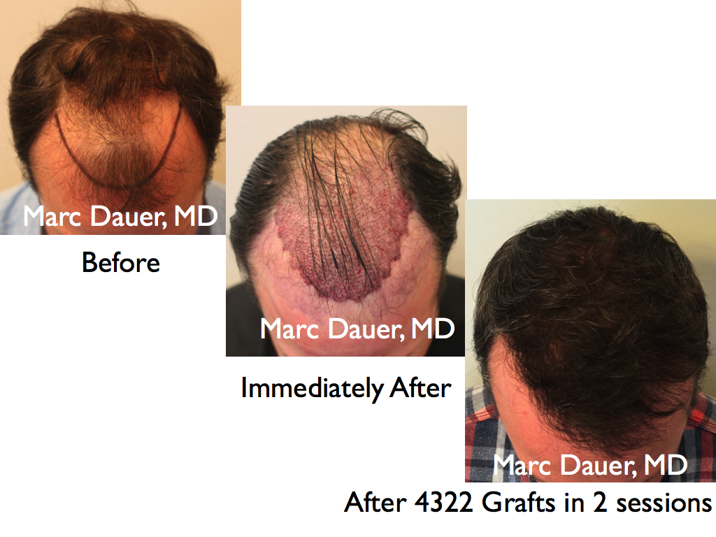 High Density Hair Transplant | Marc Dauer, MD Hair Transplant Doctor Los  Angeles