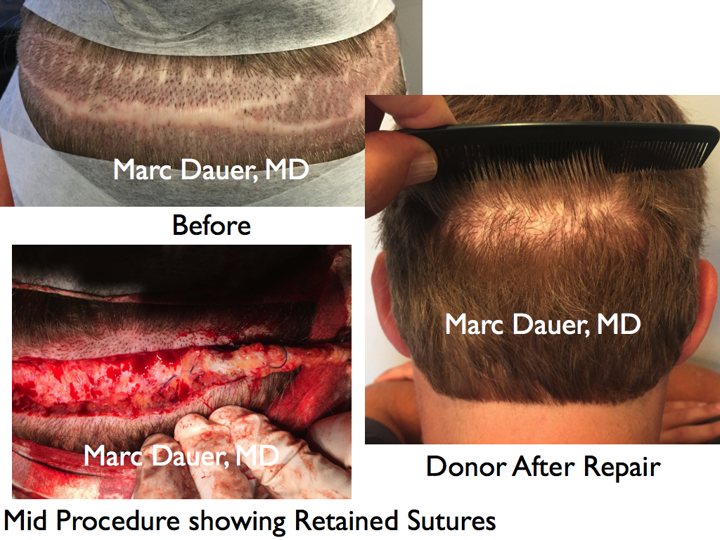 hair transplant strip scar revision