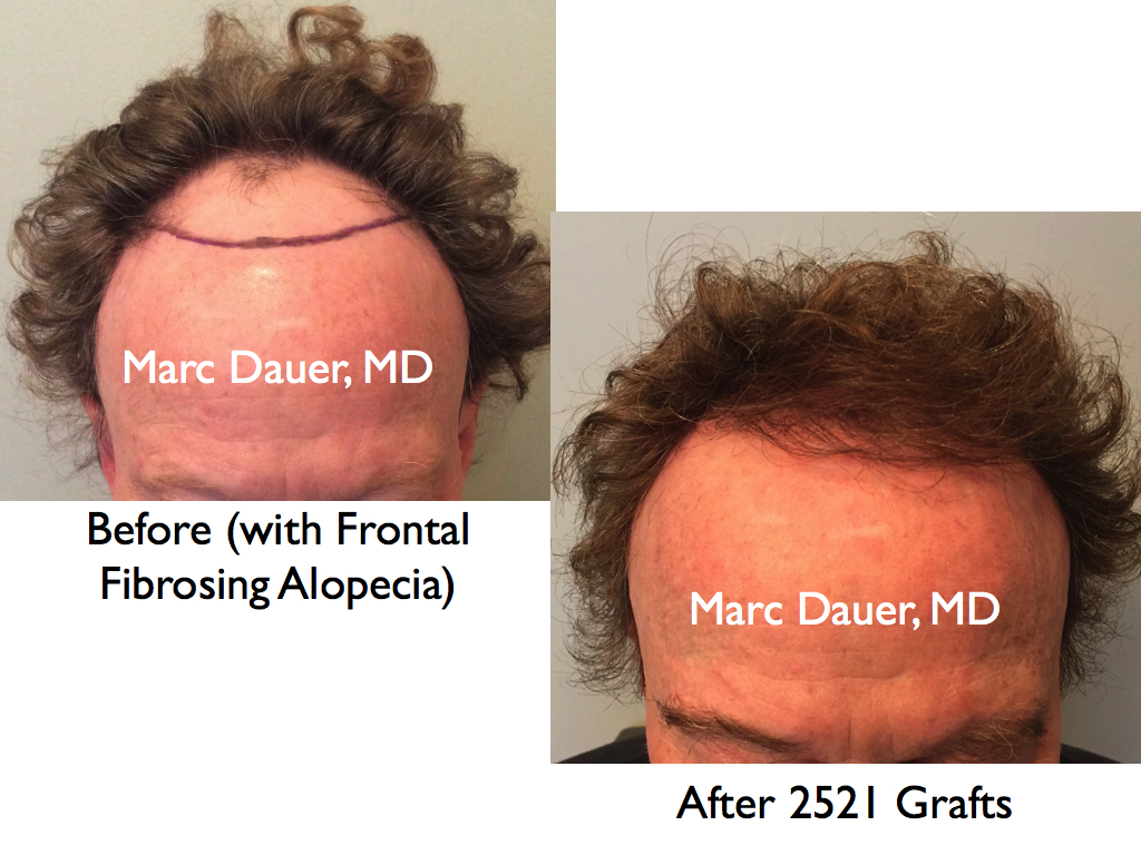Patient with Scarring Alopecia who received a hair transplant