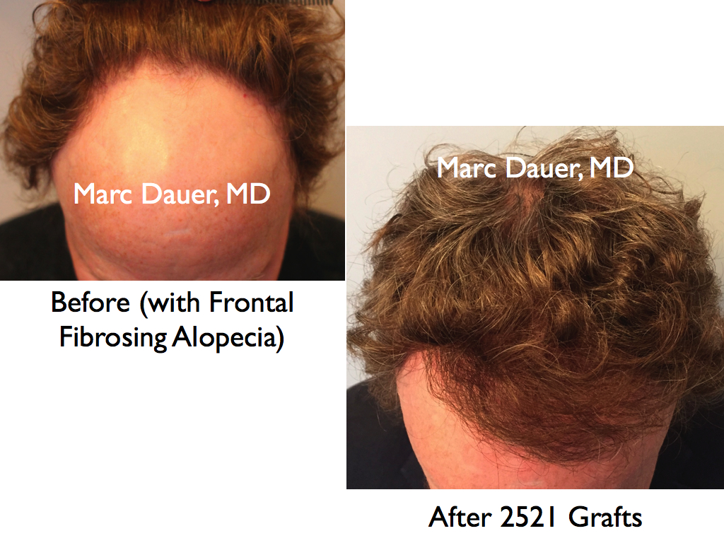 Patient with Scarring Alopecia who received a hair transplant