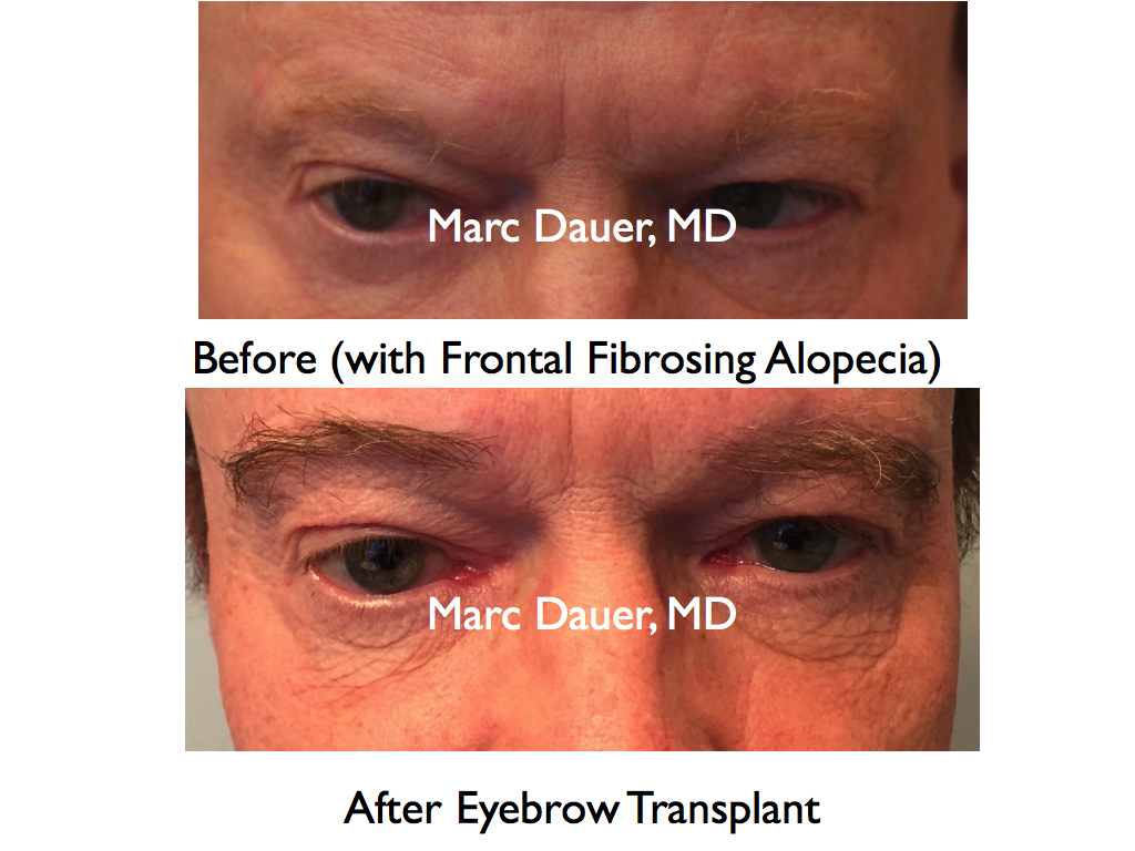 Patient with Scarring Alopecia who received an eyebrow transplant