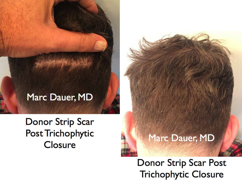 This is the donor zone after the patient had a strip harvest for hair transpant.