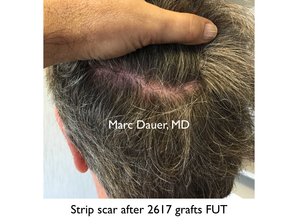 Strip scar after hair transplant. patient of Dr. Marc Dauer