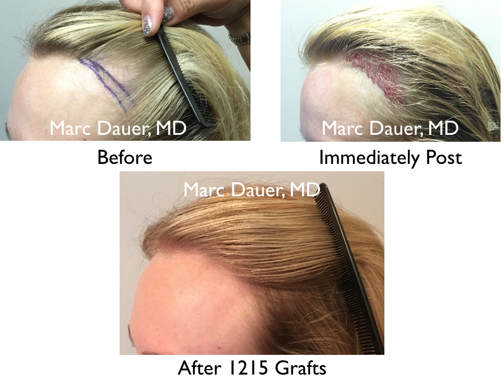 hair transplant to temporal recessions