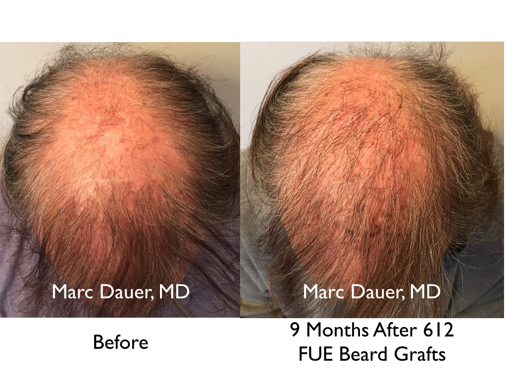 beard hair extracted via FUE transplanted to the scalp