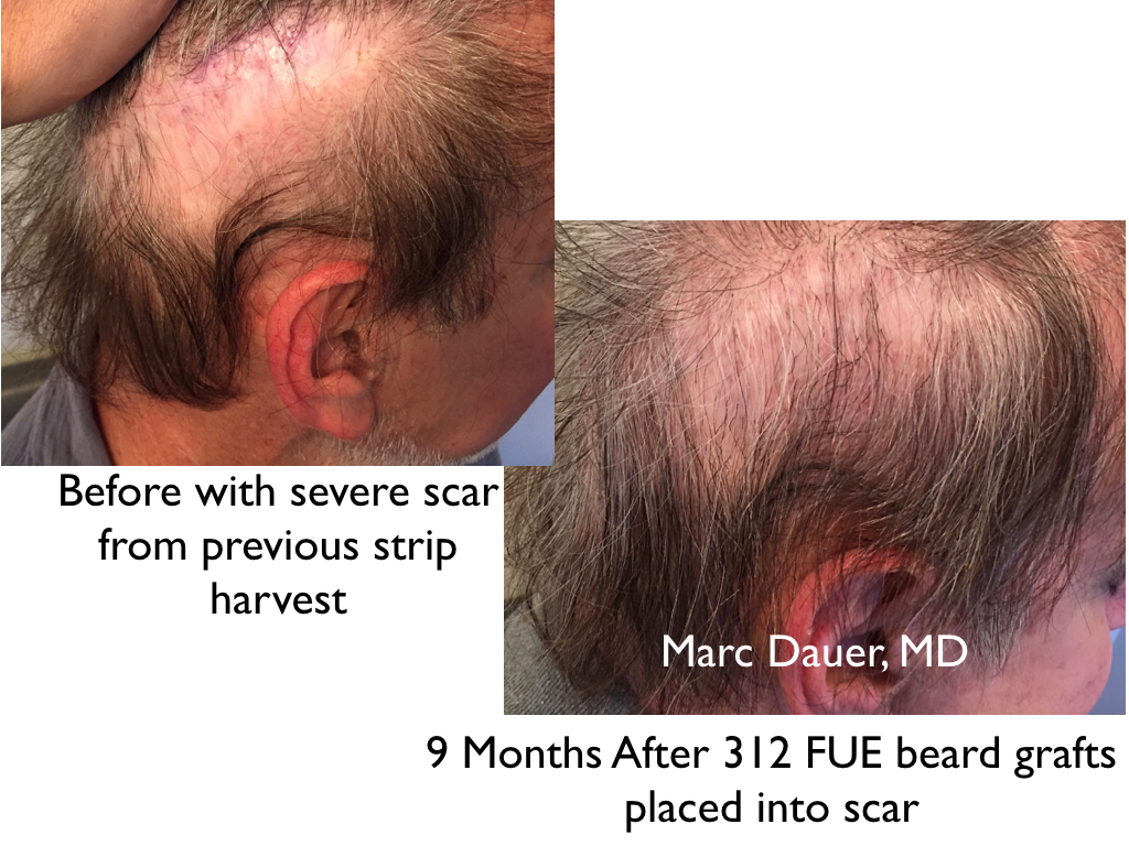 beard hair follicles extracted via FUE and transplanted into strip scar