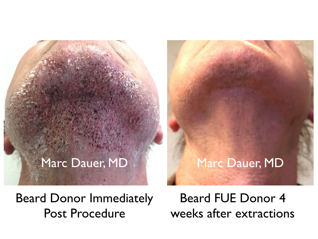 beard hairs extracted via FUE