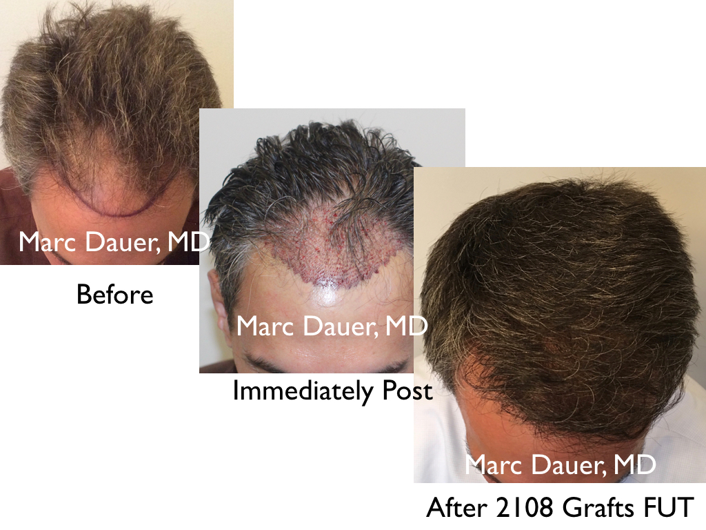 hair transplant patient of Dr. Marc Dauer