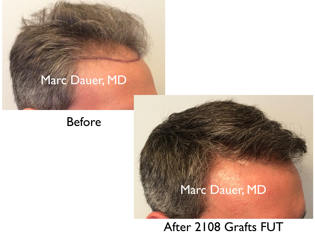 hair transplant patient of Dr. Marc Dauer