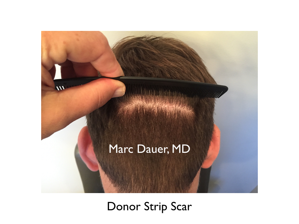 hair transplant strip scar