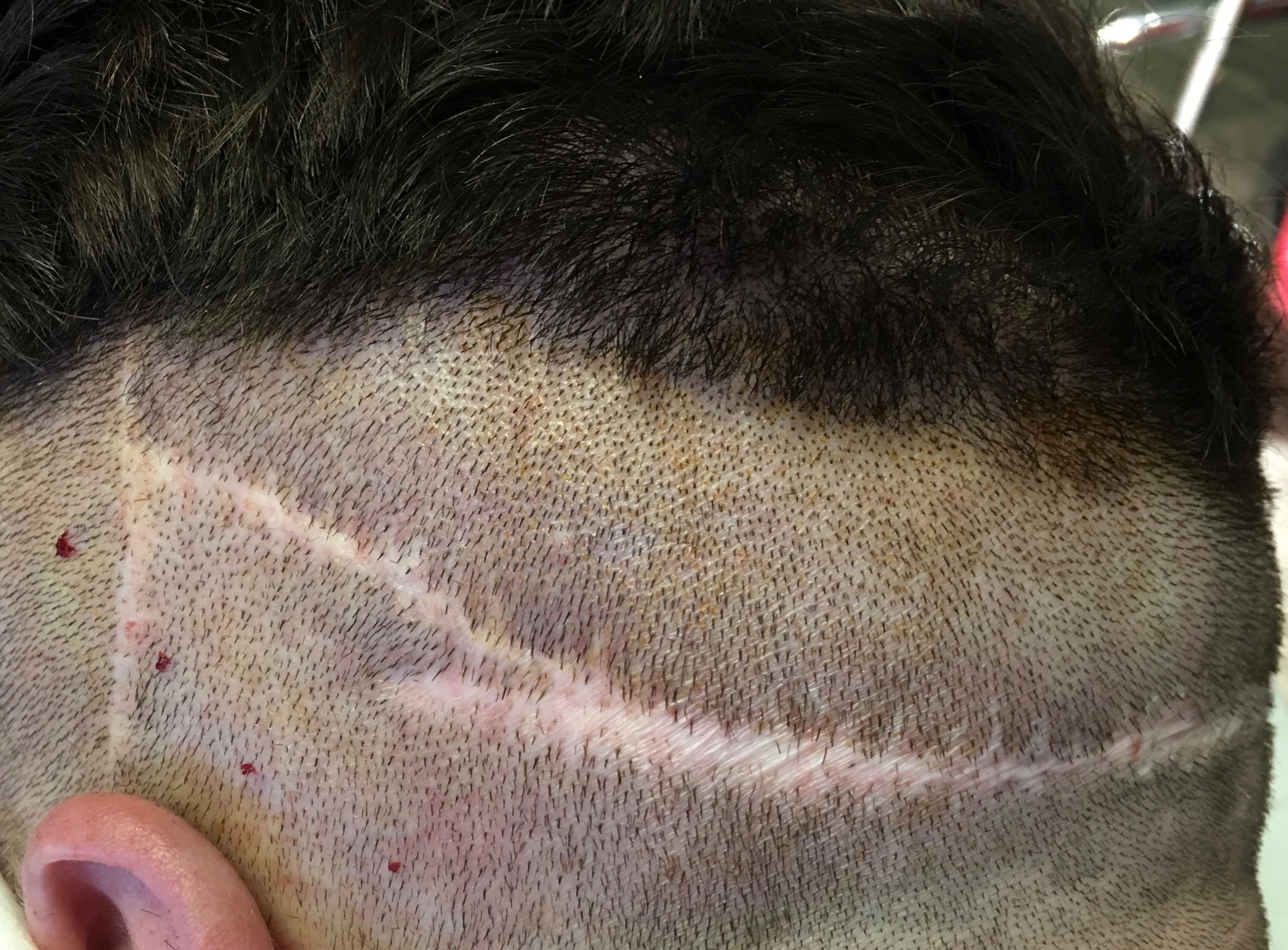 bad hair transplant strip scar