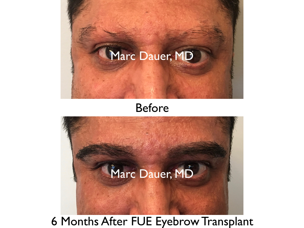 before and after FUE eyebrow transplant