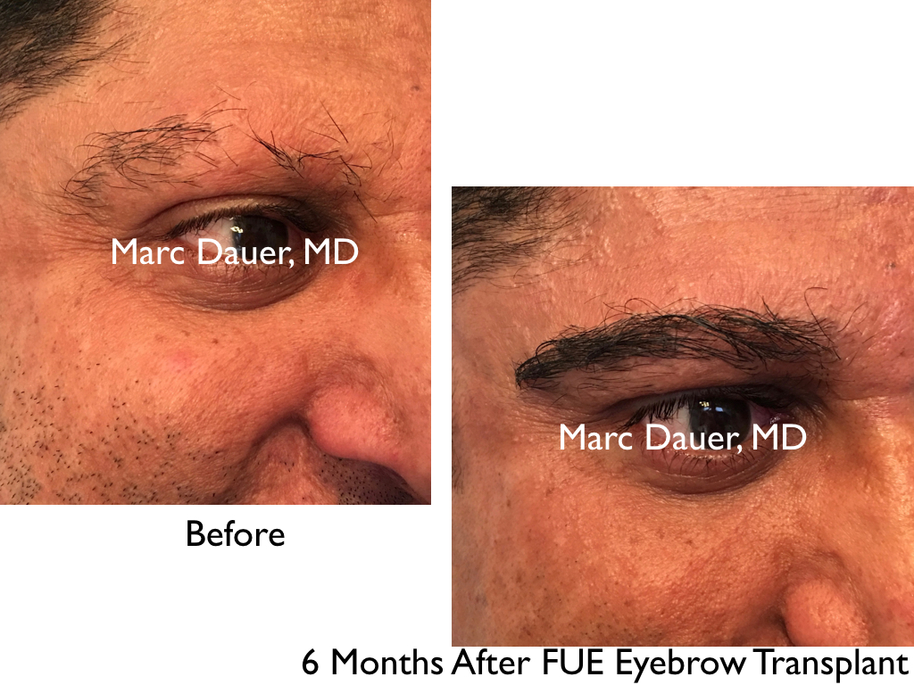 before and after FUE eyebrow transplant