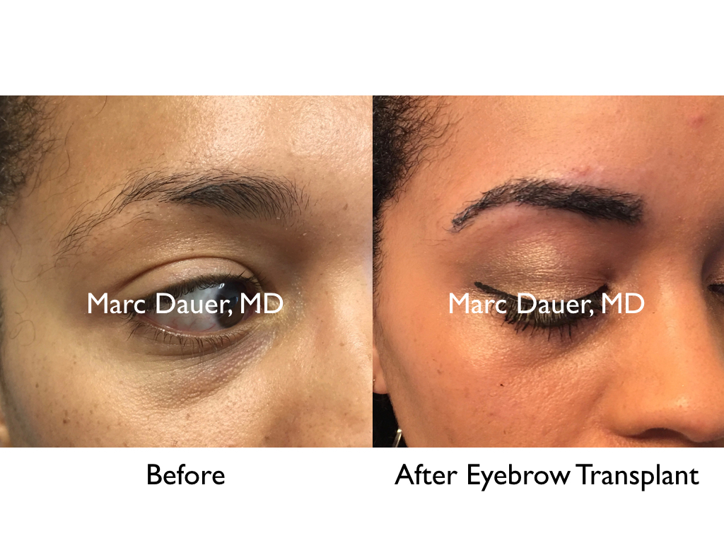 eyebrow transplant in an African American Female patient
