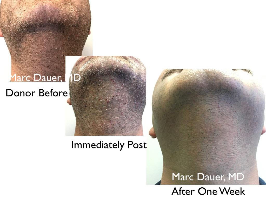 this is the donor region for grafts harvested via FUE for transplantation into the mustache 
