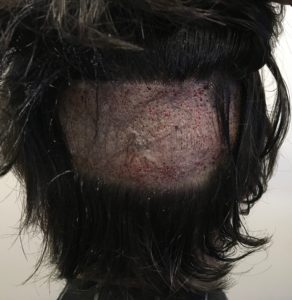 This is a patient's donor region immediately post harvesting approximately 1400 grafts via FUE with the hair raised.