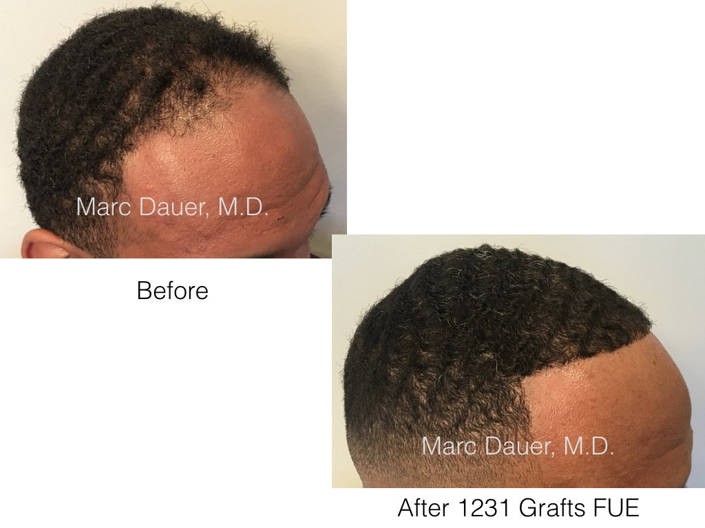 69 Best FUE Hair Transplant Doctors in the world: reviews and cost of a  consultation