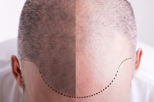 FUE Hair Transplant in Beverly Hills, CA