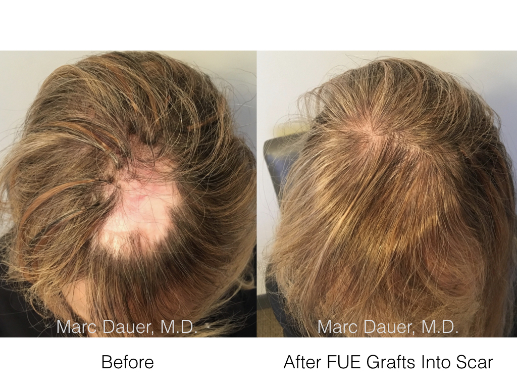 FUE Hair Transplant Into Scalp Scar | Marc Dauer, MD Hair Transplant Doctor  Los Angeles