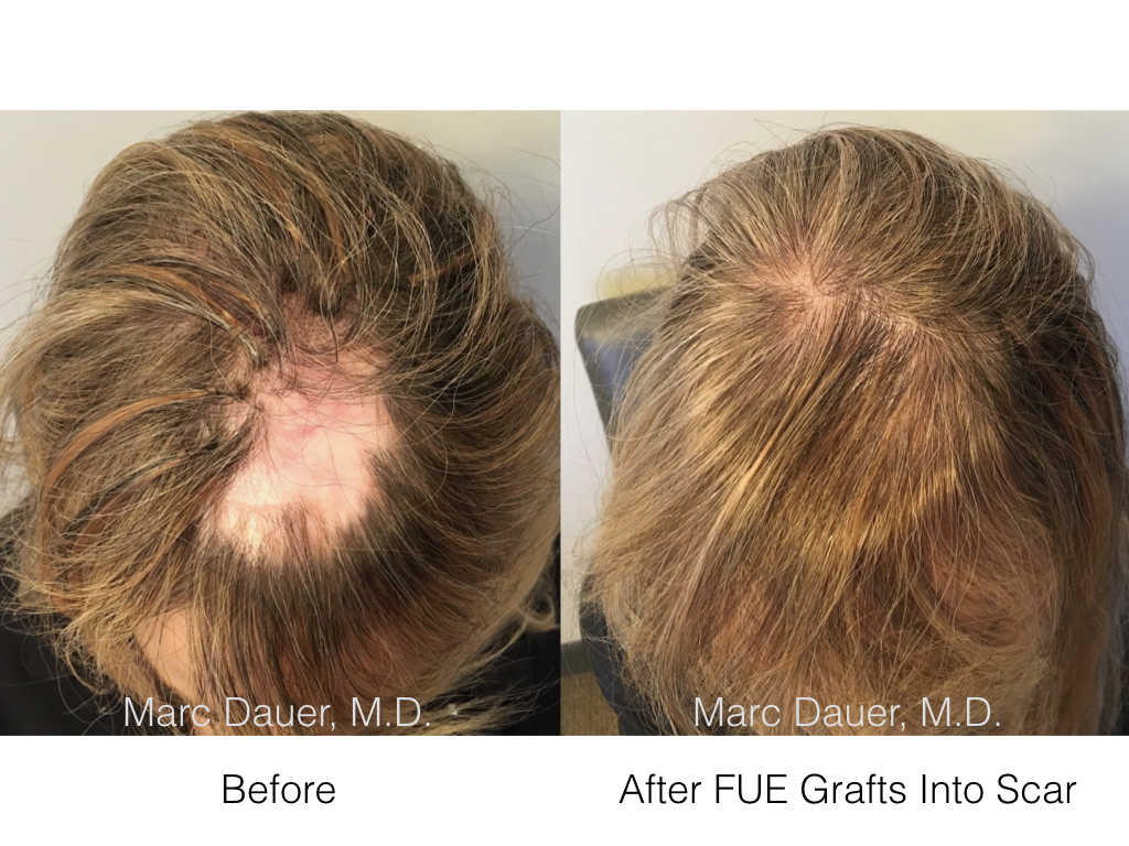 FUE Hair Transplant Into Scalp Scar Marc Dauer MD Hair Transplant 