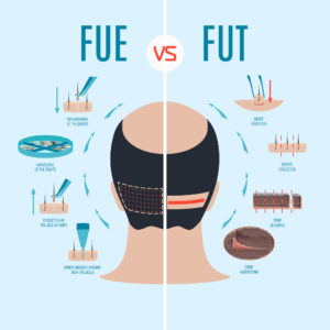 Strip Method Harvesting hair transplant (F.U.T) VS F.U.E