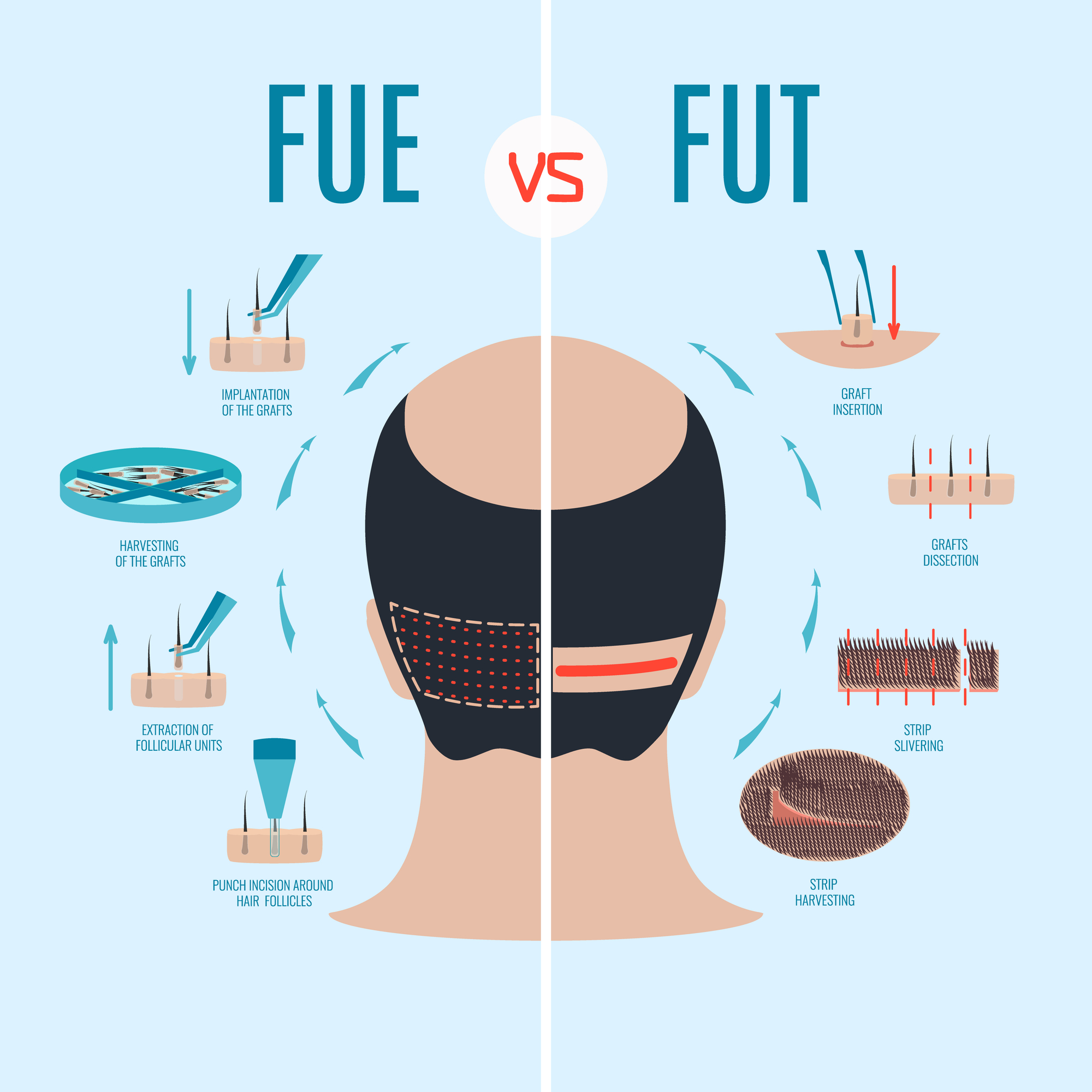 Strip Method Harvesting Hair Transplant VS FUE Hair Transplant Los 