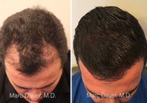 Hair Transplant Los Angeles | Marc Dauer, MD Hair Transplant Los Angeles | Marc Dauer, MD