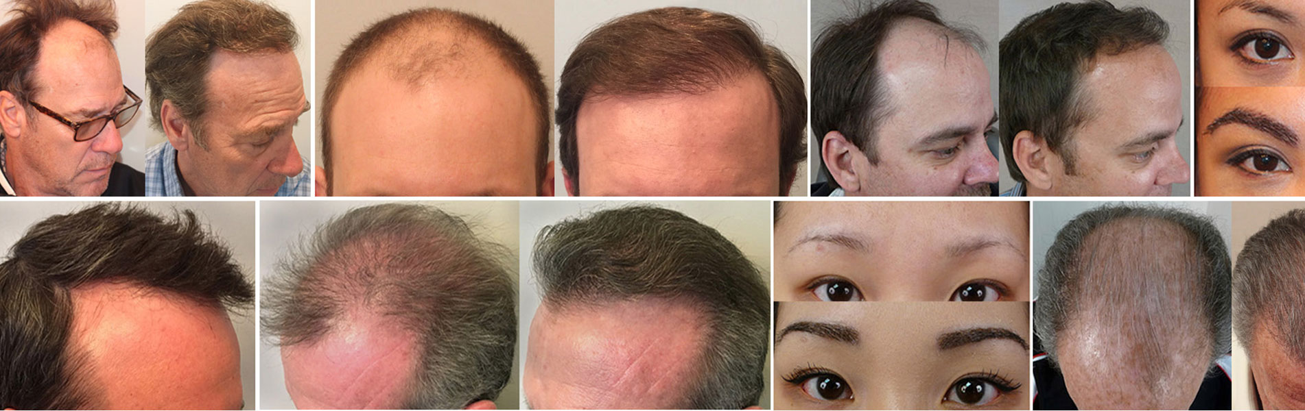 What Are The Important Factors For Hair Successful Hair Transplantation? -  Hair Sure
