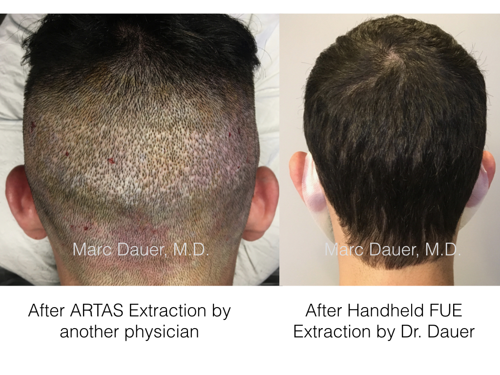 Artas Robotic Fue Versus Handheld Manual Fue Marc Dauer Md Hair Transplant Doctor Los Angeles